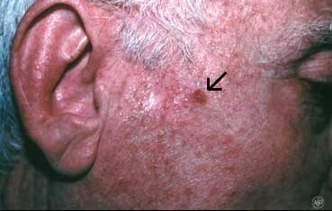 squamous carcinoma dermatology melanoma aad scc basal cellule dawes cancro exposure badly